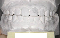 新潟市　東区　桑原歯科医院　歯科模型　3